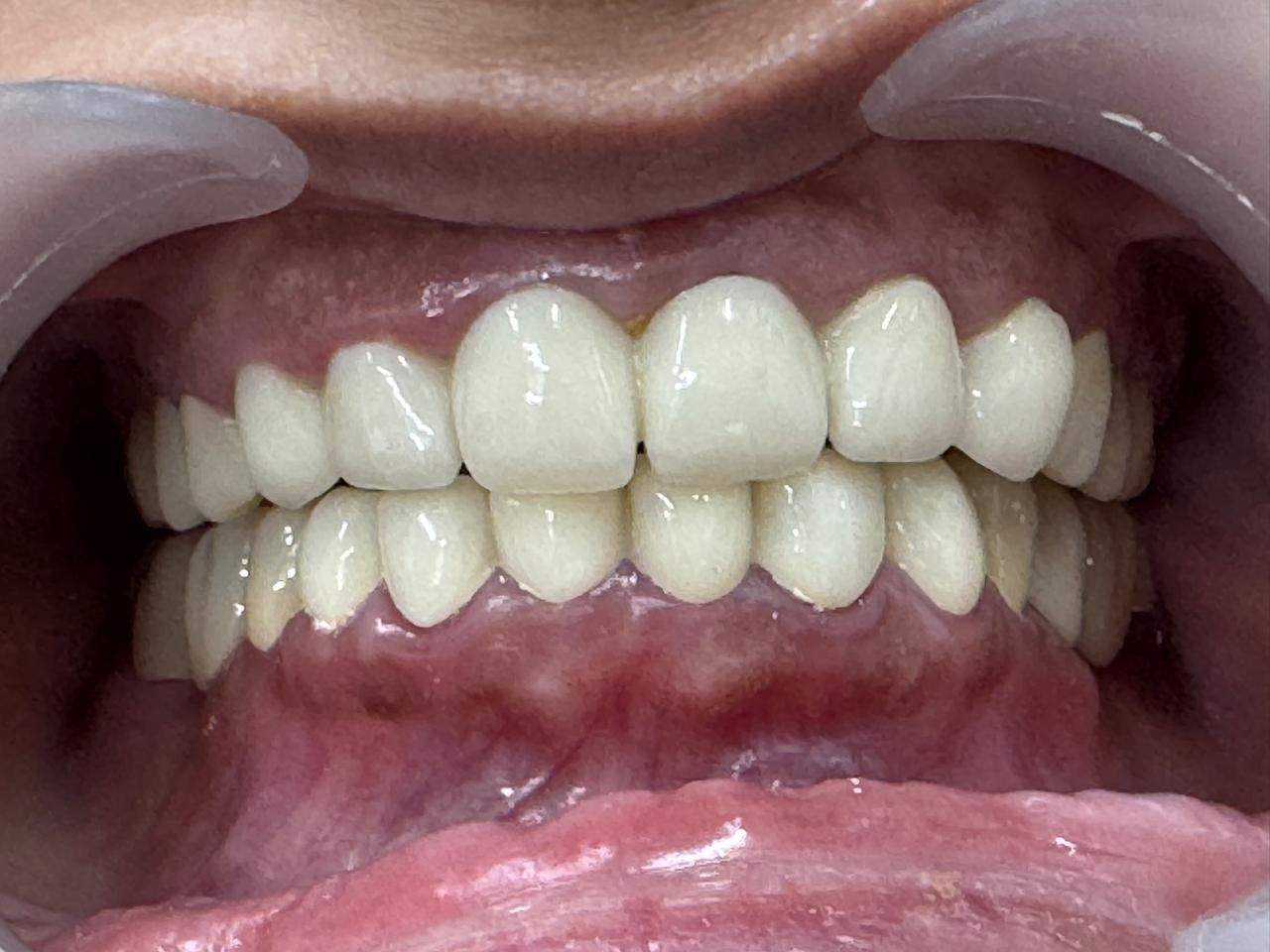 Full mouth rehabilitation: Severely attrited teeth restored with multiple root pins and zirconium crowns treatment